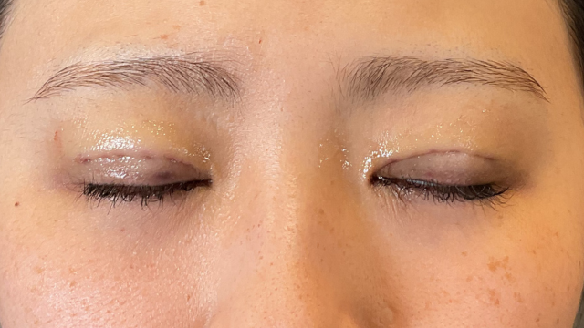 Postoperative Condition Part 1