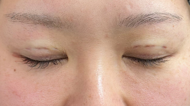 Postoperative Condition Part 1