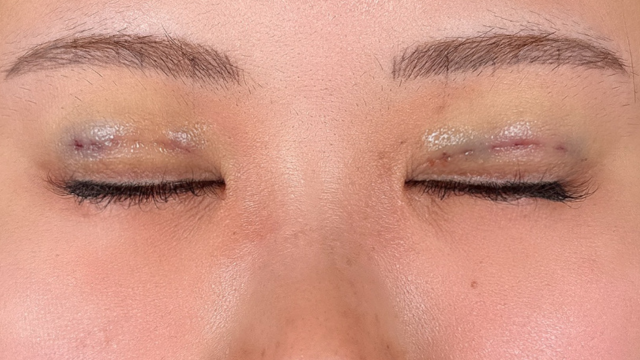 Postoperative Condition Part 1