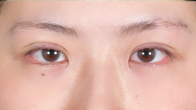 Postoperative Condition Part 1