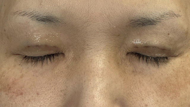 Postoperative Condition Part 1