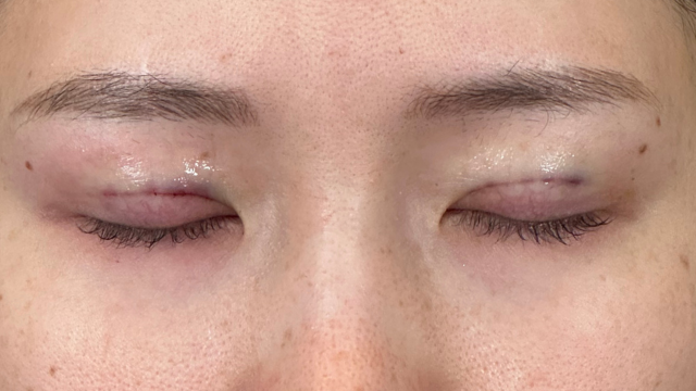 Postoperative Condition Part 1