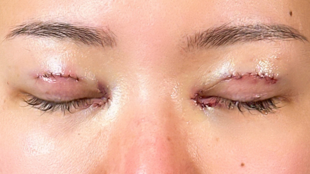 Postoperative Condition Part 1