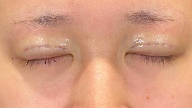 Postoperative Condition Part 1