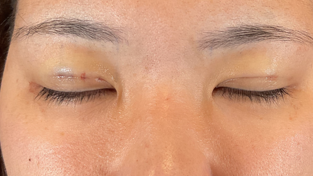 Postoperative Condition Part 1