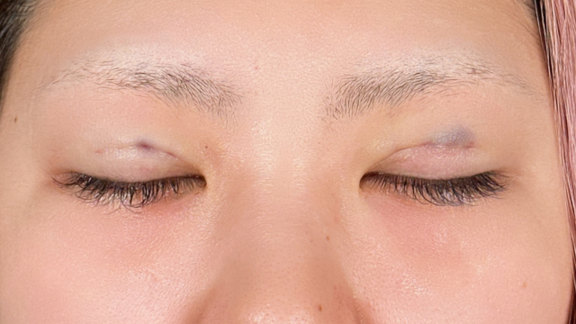 Postoperative Condition Part 1