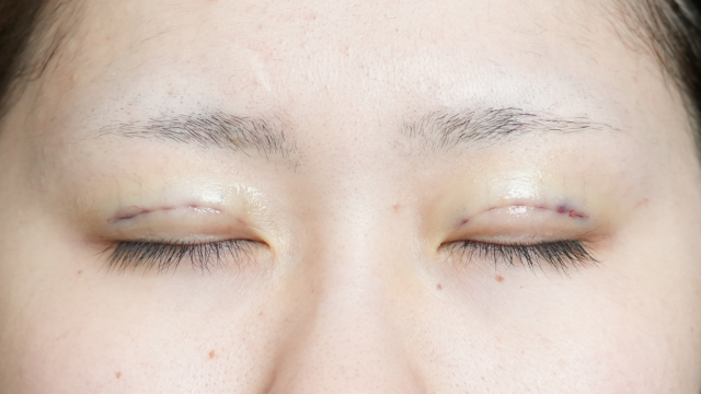 Postoperative Condition Part 1