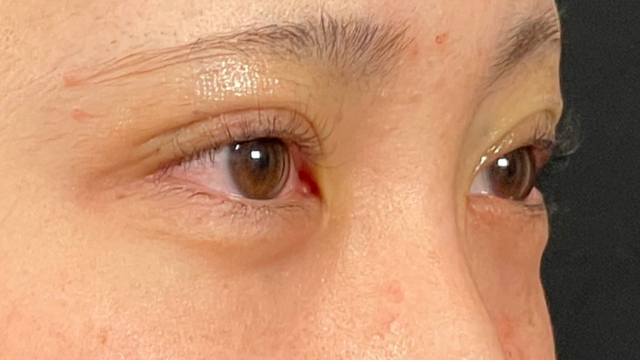 Postoperative Condition Part 1