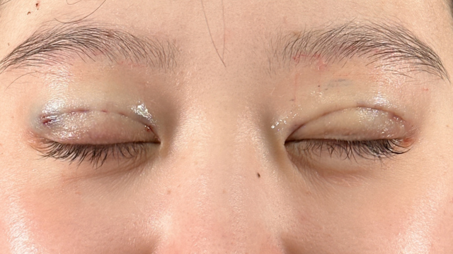 手術前の状態 その1