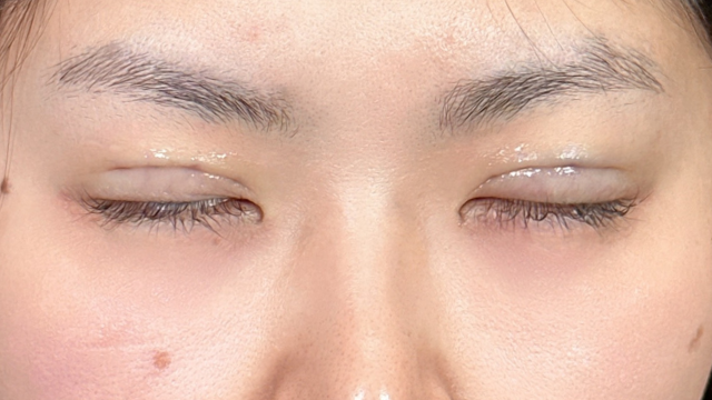 Postoperative Condition Part 1