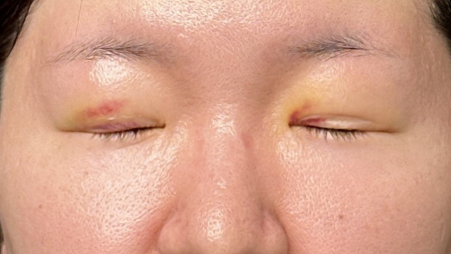 Postoperative Condition Part 1