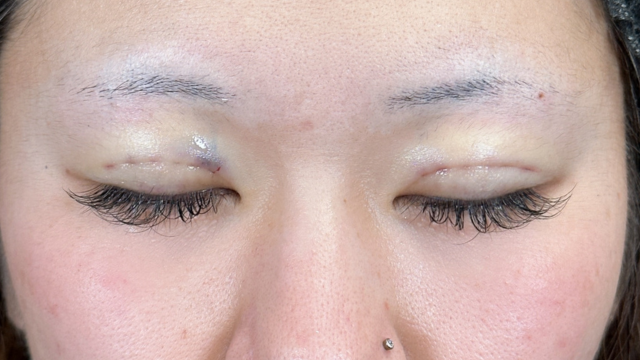 Postoperative Condition Part 1