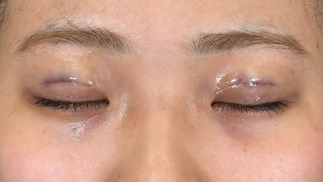 Postoperative Condition Part 1