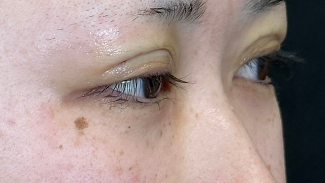 Postoperative Condition Part 1