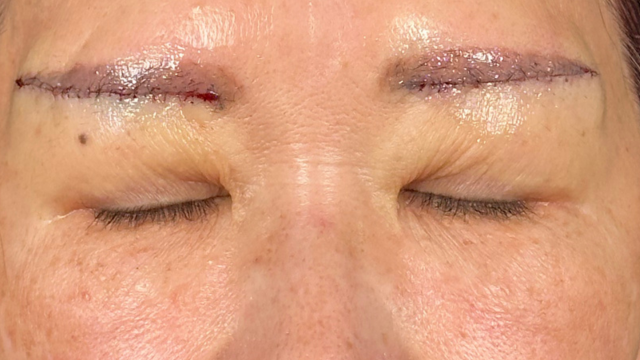 Postoperative Condition Part 1