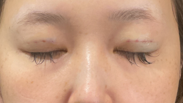 Postoperative Condition Part 1