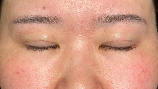 Postoperative Condition Part 1