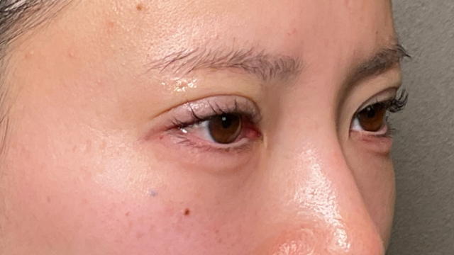 Postoperative Condition Part 1