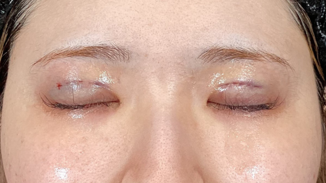 Postoperative Condition Part 1