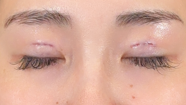 Postoperative Condition Part 1