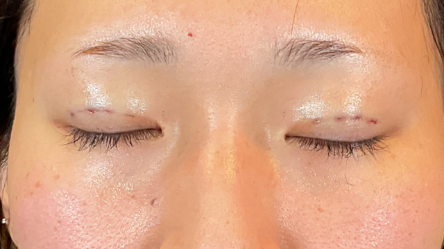 Postoperative Condition Part 1