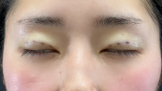 Postoperative Condition Part 1