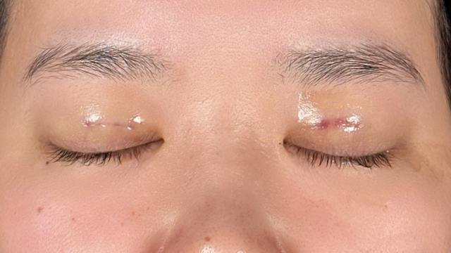 Postoperative Condition Part 1