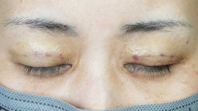 Postoperative Condition Part 1