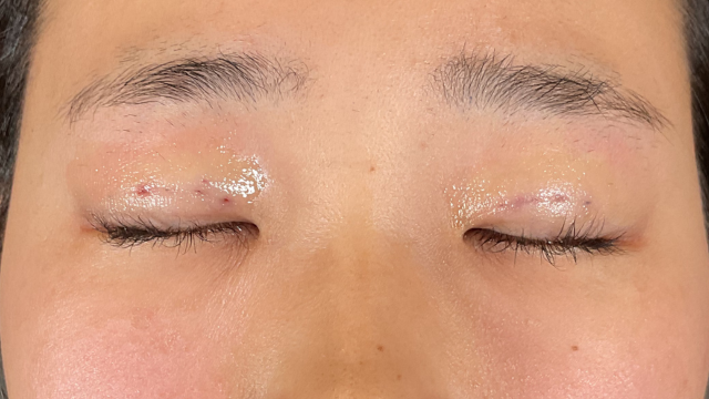 Postoperative Condition Part 1