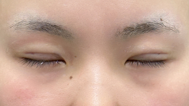 Postoperative Condition Part 1