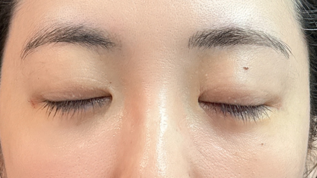 Postoperative Condition Part 1