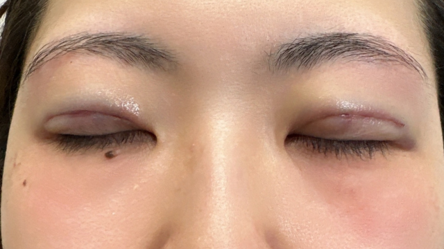 Postoperative Condition Part 1