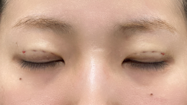 Postoperative Condition Part 1