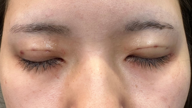 Postoperative Condition Part 1