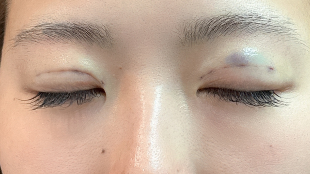 Postoperative Condition Part 1