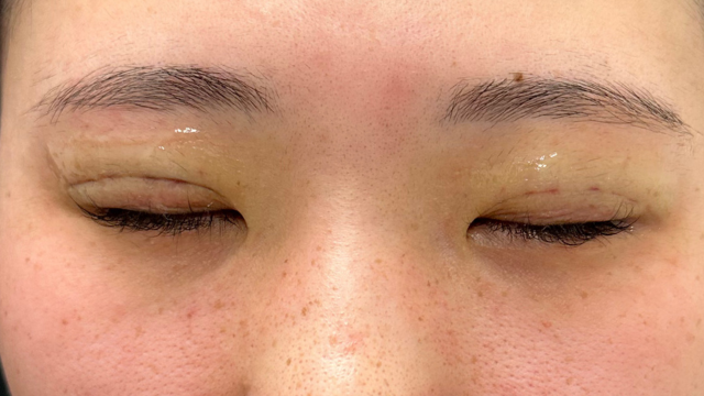 Postoperative Condition Part 1