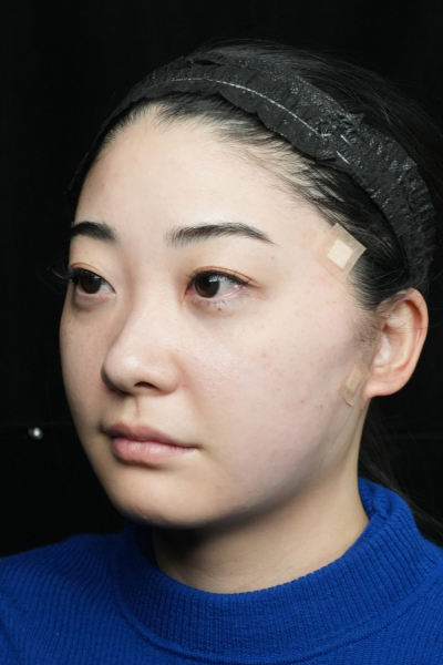 手術前の状態 その1