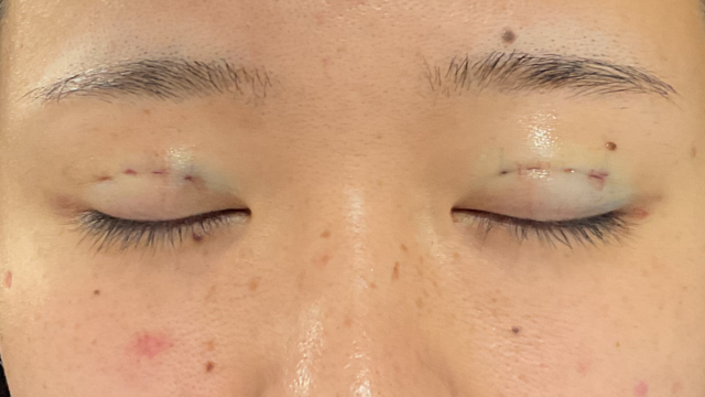 Postoperative Condition Part 1