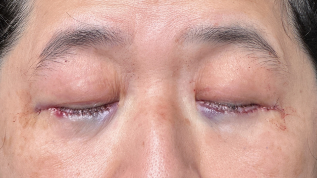 Postoperative Condition Part 1