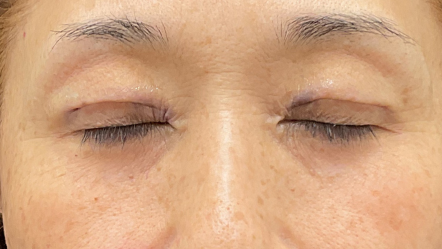 Postoperative Condition Part 1