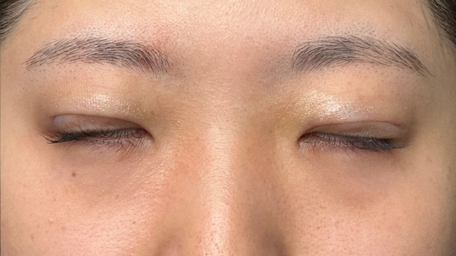 Postoperative Condition Part 1