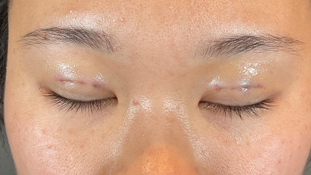 Postoperative Condition Part 1