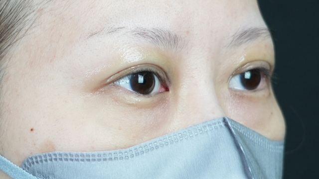 Postoperative Condition Part 1