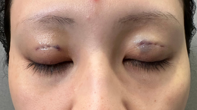 Postoperative Condition Part 1