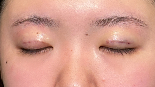 Postoperative Condition Part 1