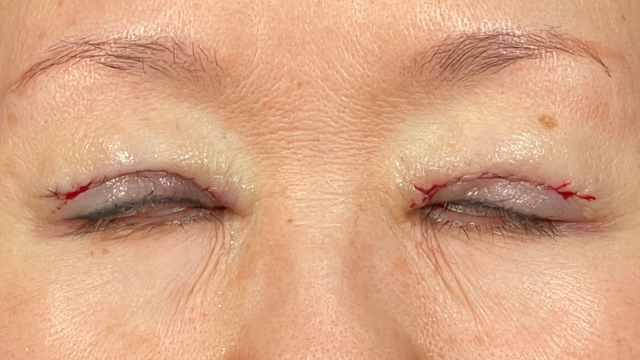 Postoperative Condition Part 1