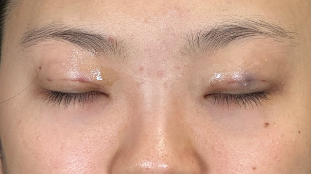 Postoperative Condition Part 1