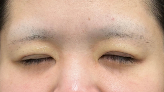 Postoperative Condition Part 1