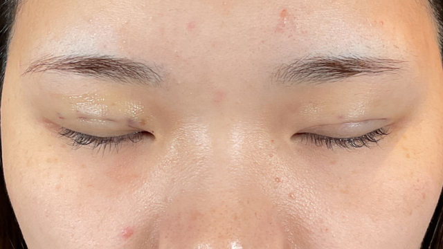 Postoperative Condition Part 1