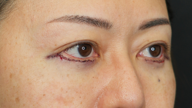 Postoperative Condition Part 1